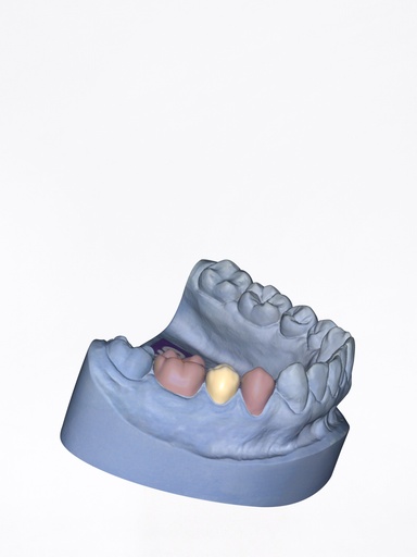 DentalCAD - Modulo Provvisori