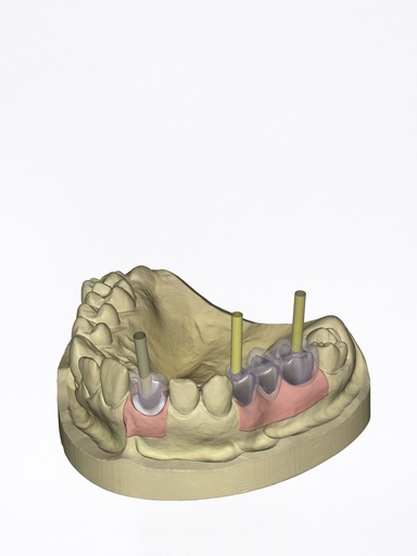 DentalCAD - Modulo Impianti Flex