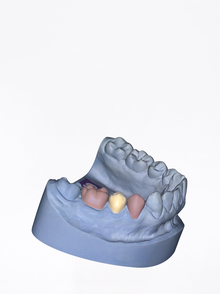 DentalCAD - Modulo Provvisori