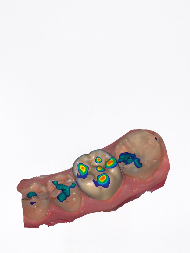 ChairsideCAD - Modulo Articolatore Auto