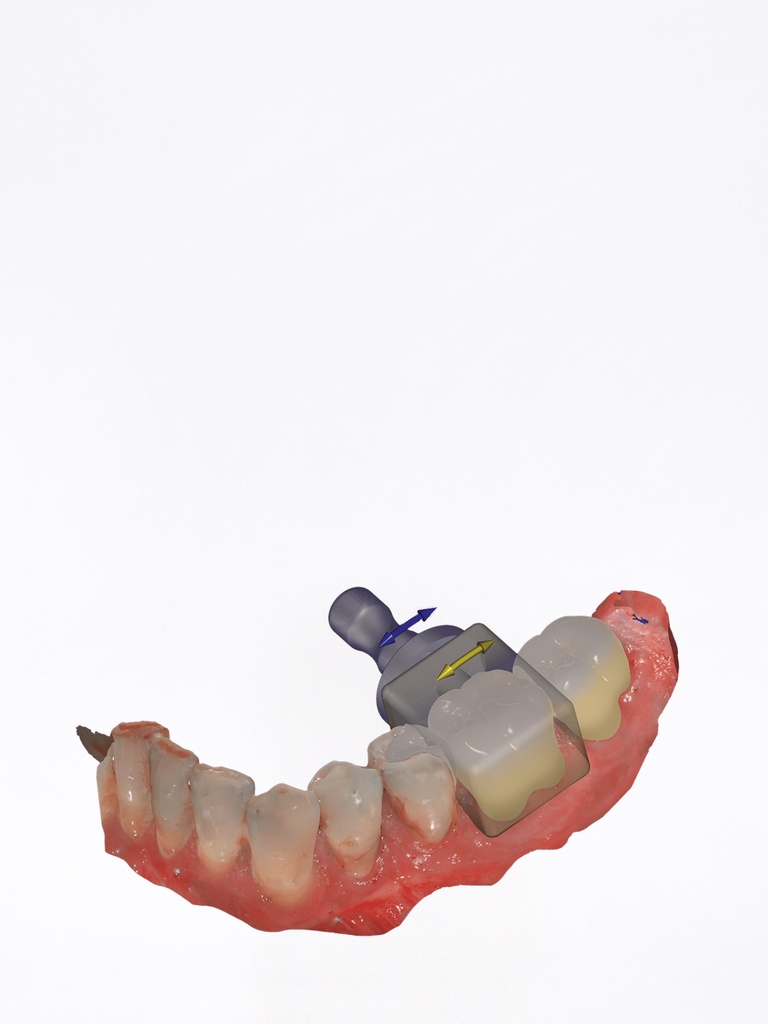 ChairsideCAD - Modulo In-CAD Nesting